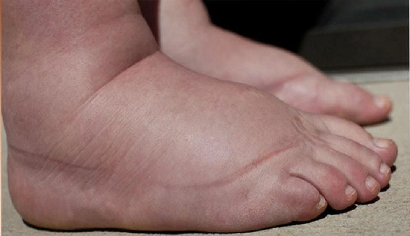 Khám phá hình ảnh bệnh phù chân voi thực tế rõ nét