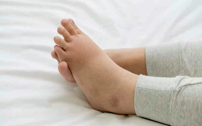 Thực tế ảnh người bị phù chan voi khiến nhiều người quan tâm
