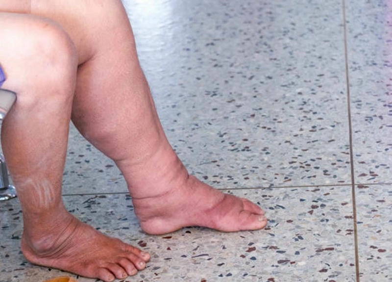 Thông tin chi tiết về bệnh phù chân voi và triệu chứng