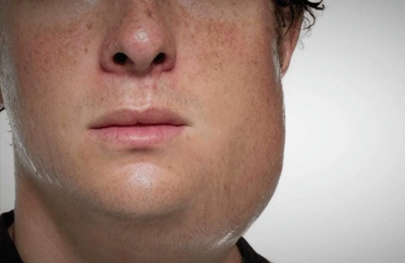 Tìm hiểu bị bệnh quai bị có ảnh hưởng gì không rõ ràng