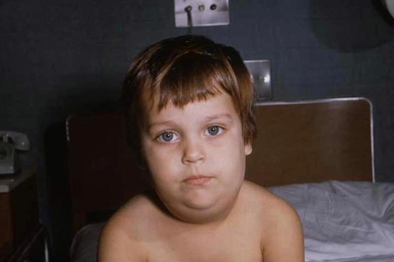 Tìm hiểu kỹ bé trai bị quai bị có ảnh hưởng gì không dễ hiểu