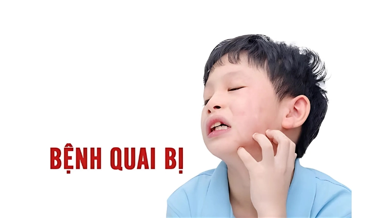 Hình ảnh bệnh quai bị ở trẻ em và người lớn chi tiết nhất