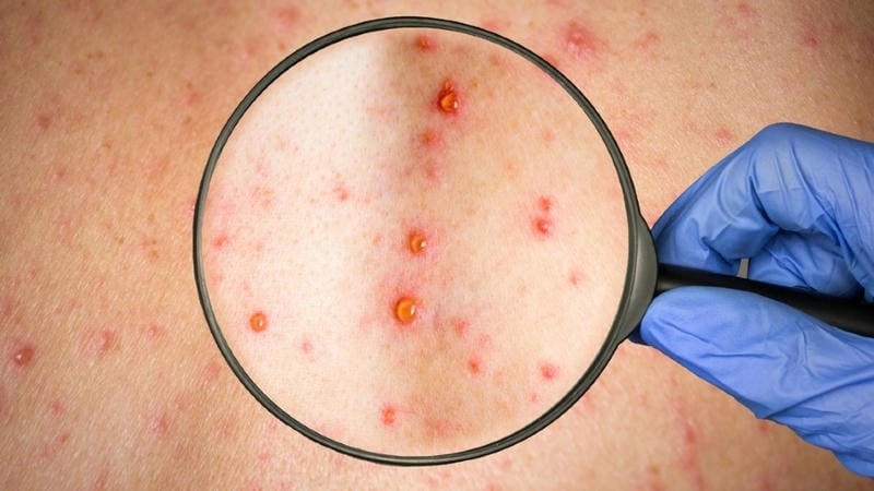 ảnh dịch bệnh rubella được cập nhật liên tục