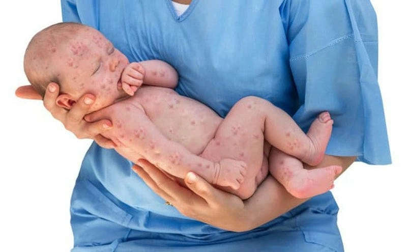 Bệnh rubella có thể bùng phát thành dịch