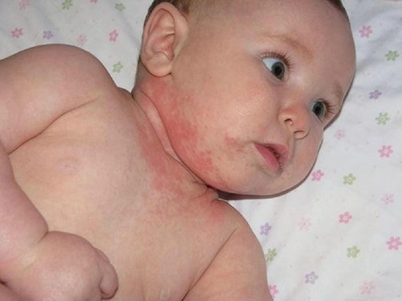 Bệnh rubella ở trẻ lây lan nhanh