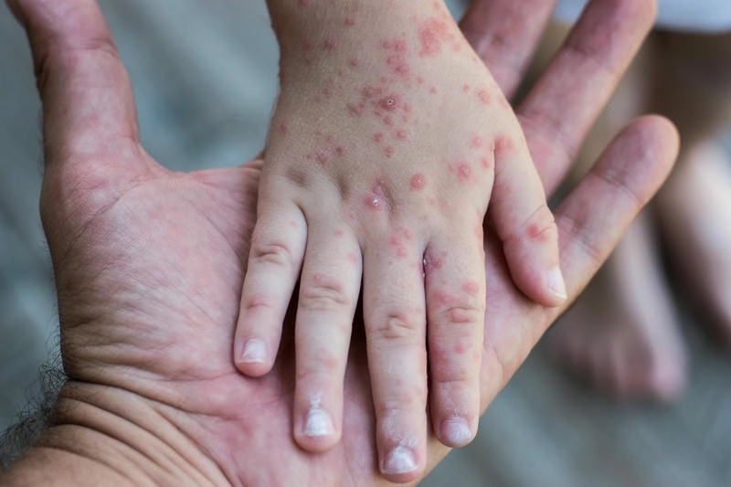 Hình ảnh bệnh rubella dễ nhận biết