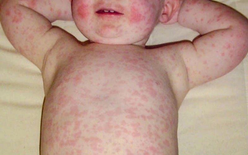 Triệu chứng bệnh rubella ở trẻ em khá dễ nhầm
