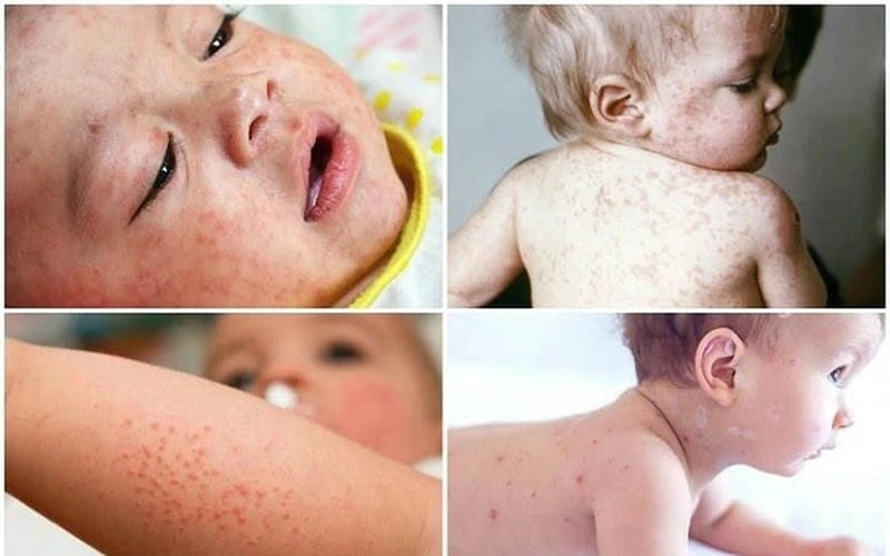 Bệnh rubella ở trẻ nhỏ thường phát ban đỏ