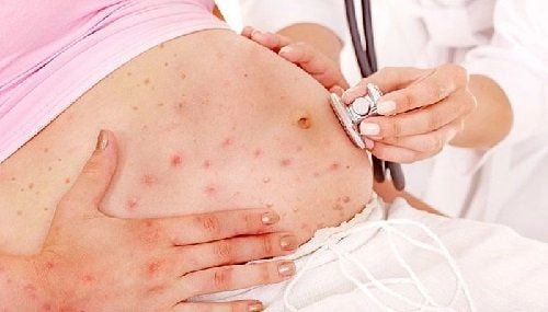 Ảnh bệnh rubella ở phụ nữ mang thai gây nguy cơ dị tật