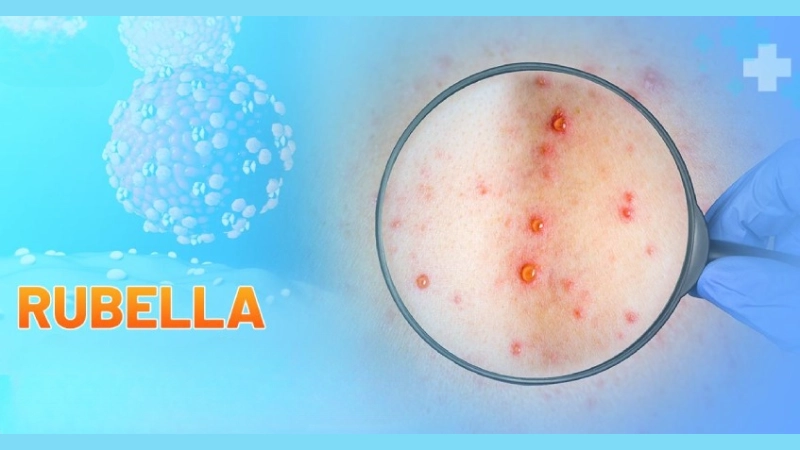 Hình ảnh bệnh rubella dễ nhận biết qua từng giai đoạn