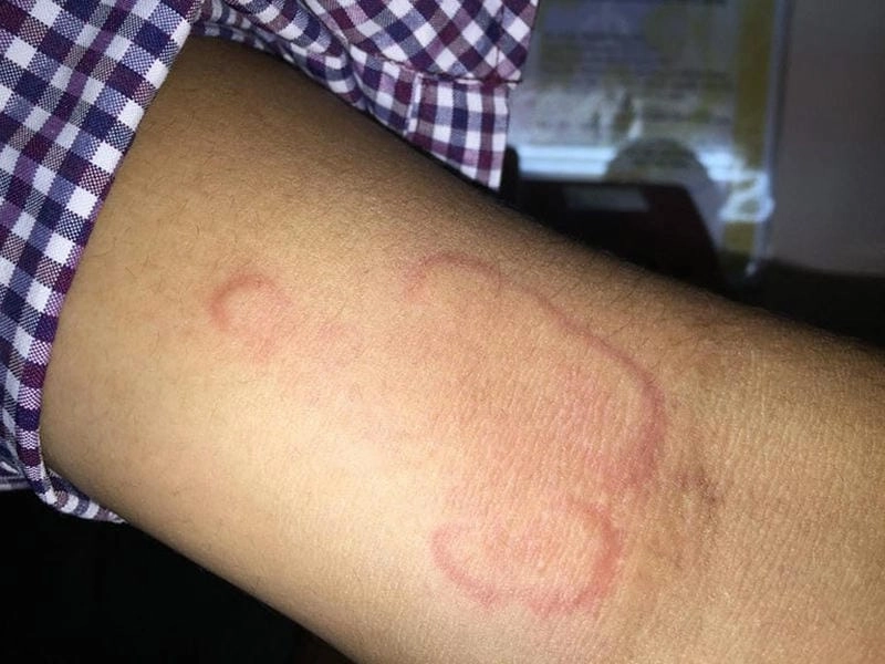 Hình ảnh về sán chó gây ngứa ngáy và viêm da nghiêm trọng