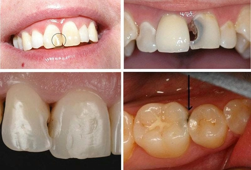 Cảnh báo biến chứng viêm lợi do sâu răng