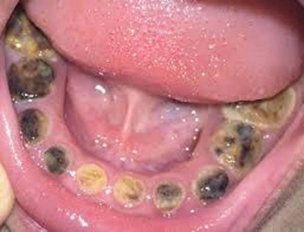 Cận cảnh chi tiết hình ảnh răng sâu nặng