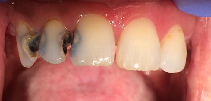 Lưu ý nguy hiểm khi sâu răng biến chứng