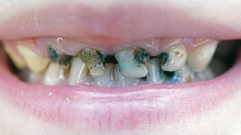 Xem chi tiết hình ảnh trẻ em bị sâu răng