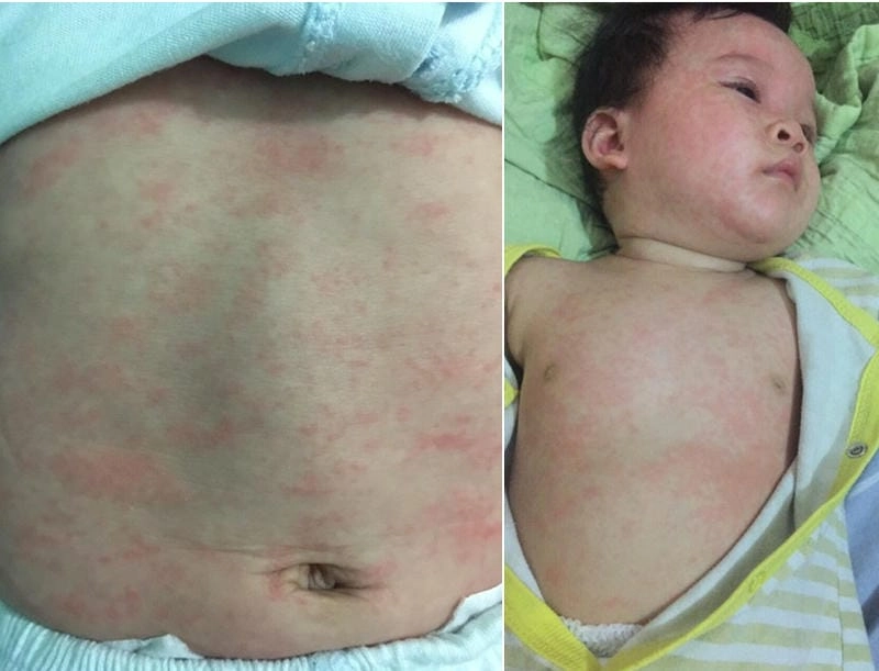 Phân biệt sốt phát ban hình ảnh bệnh sởi ở trẻ em chính xác
