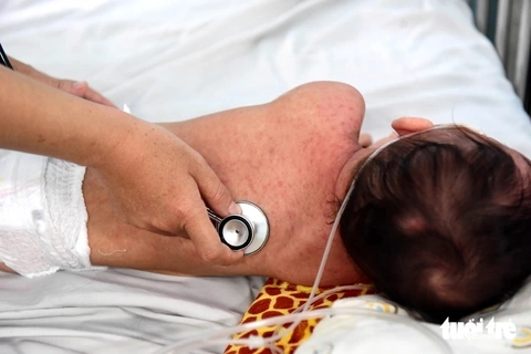 Tìm hiểu sởi ở trẻ em triệu chứng ban đầu dễ quan sát