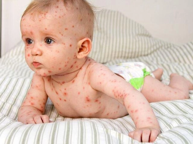 Phát hiện sớm nhờ hình ảnh bệnh sởi ở trẻ sơ sinh chính xác