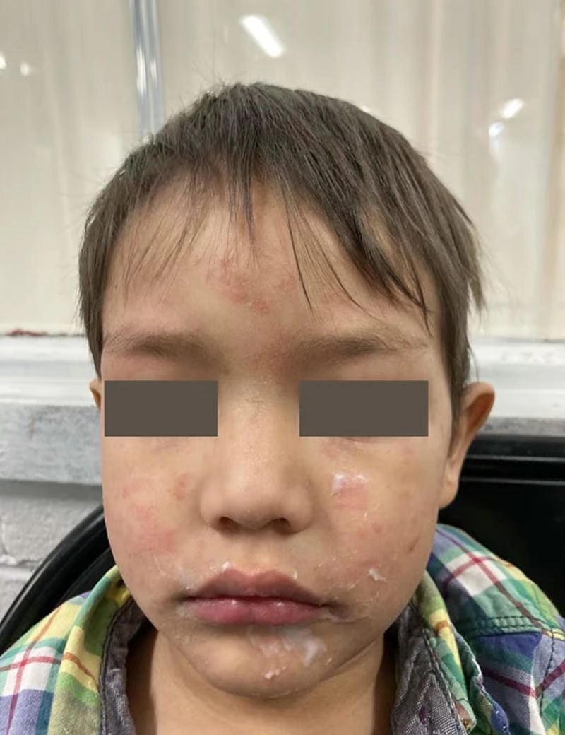 Cập nhật tình trạng qua ảnh bệnh sởi rõ ràng