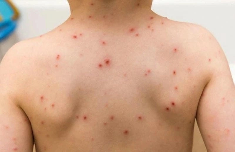 Xem dấu hiệu ban đầu qua hình ảnh bệnh sởi ở trẻ thường gặp