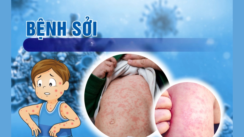 Hình ảnh bệnh sởi trẻ em qua từng giai đoạn phát triển