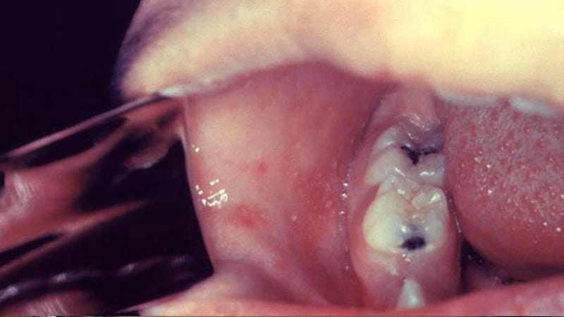 Cập nhật hình ảnh bệnh sởi ở trẻ sơ sinh