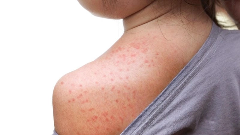 Phân biệt hình ảnh bệnh sởi ở người lớn