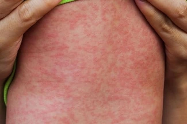 Nhận biết rõ ràng qua hình ảnh bệnh sởi thực tế
