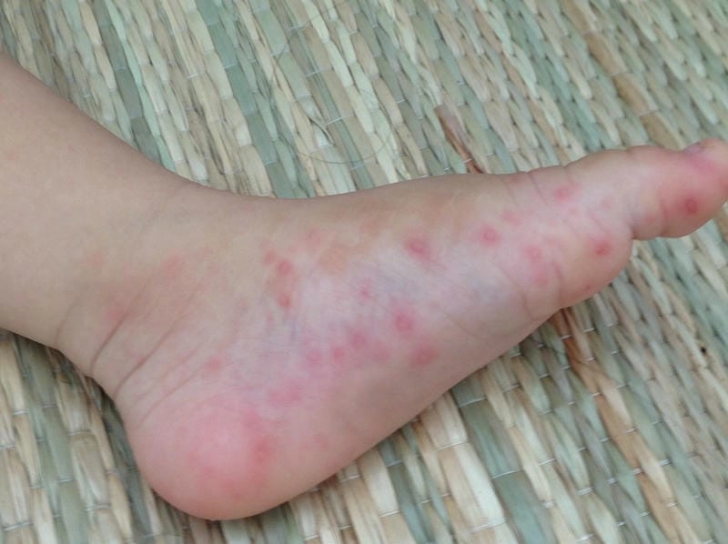 Hình ảnh bệnh sốt xuất huyết ở người lớn được cập nhật rõ nét