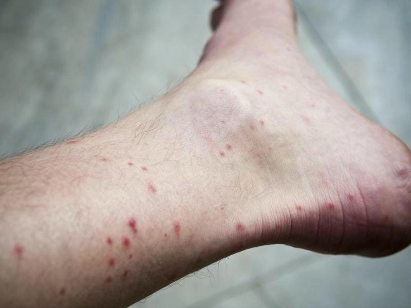 Hình ảnh con muỗi sốt xuất huyết cho thấy đặc điểm nhận dạng