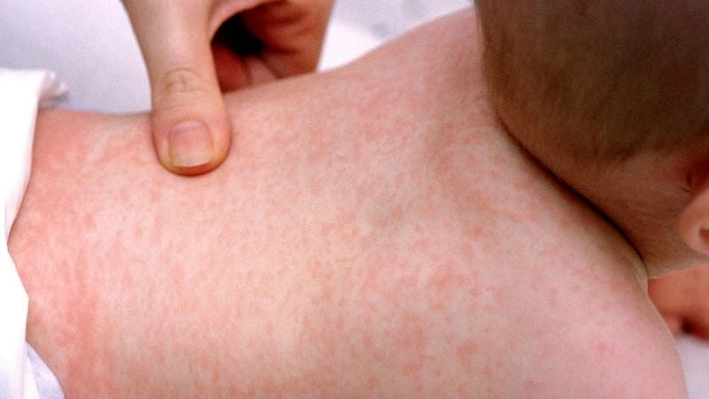 Hình ảnh phát ban sốt xuất huyết là dấu hiệu dễ nhận biết