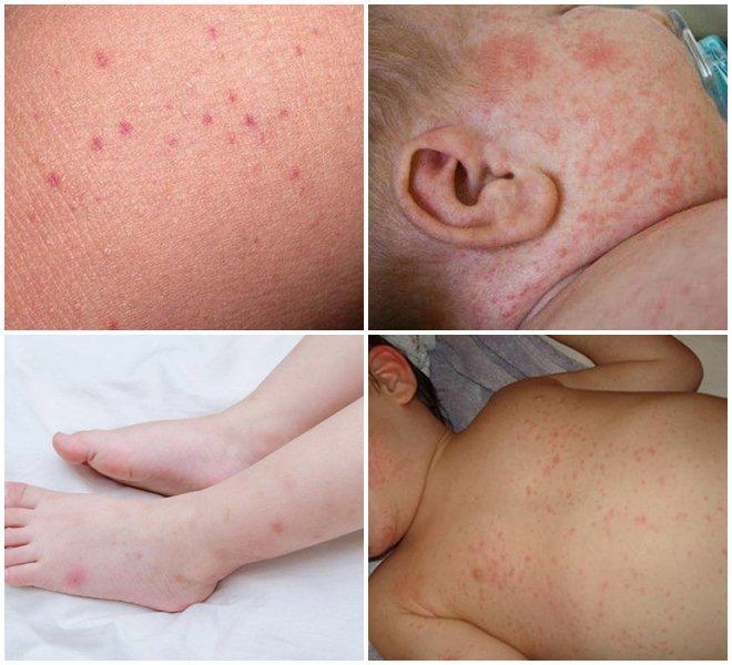Hình ảnh dấu hiệu sốt xuất huyết giúp nhận biết và điều trị kịp thời