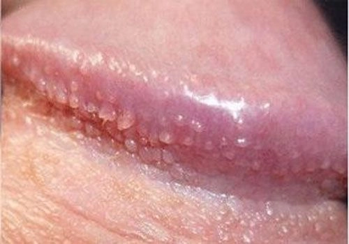 Chi tiết hình ảnh bệnh sùi mào gà ở nữ giới