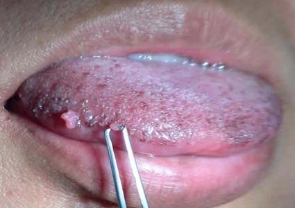 Dấu hiệu hình ảnh bệnh sùi mào gà ở lưỡi