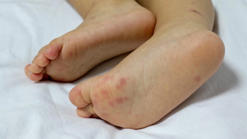 Phân biệt bệnh qua hình ảnh bệnh tay chân miệng cụ thể