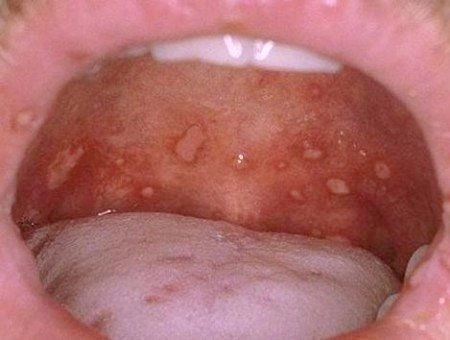 Hình ảnh bệnh tay chân miệng ở trẻ giúp mẹ nhận biết sớm