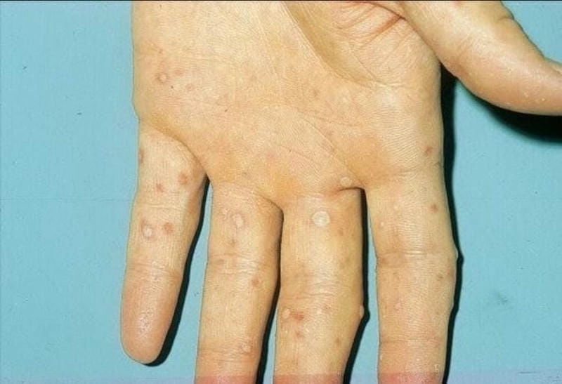 Hình ảnh bệnh tay chân miệng ở trẻ sơ sinh khó phát hiện hơn