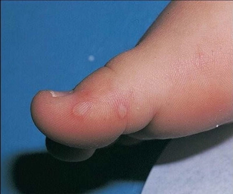 Triệu chứng sớm qua hình ảnh chân tay miệng ở trẻ nhỏ thường là sốt nhẹ