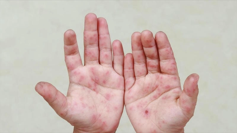 Cách nhận biết qua hình ảnh tay chân miệng ở trẻ em giai đoạn đầu