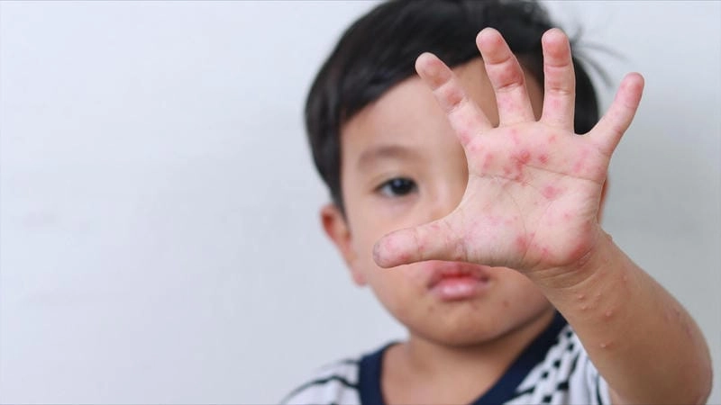 Cảnh báo dấu hiệu trong ảnh bé bị chân tay miệng