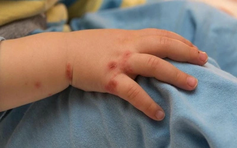 Biểu hiện ở trẻ nhỏ bệnh tay chân miệng cấp độ 1 thường gặp