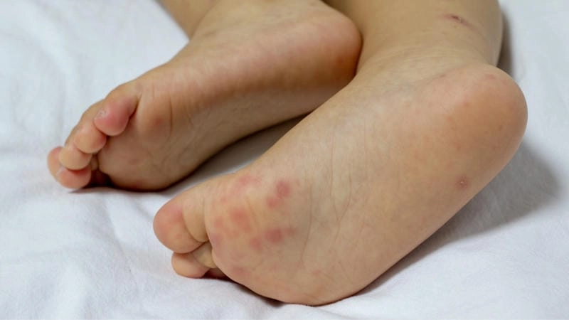 Bệnh tay chân miệng cấp độ 1 dễ lây lan nếu không xử lý kịp