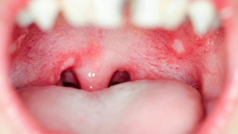 Bệnh tay chân miệng ở trẻ em cấp độ 1 thường gặp vào mùa hè