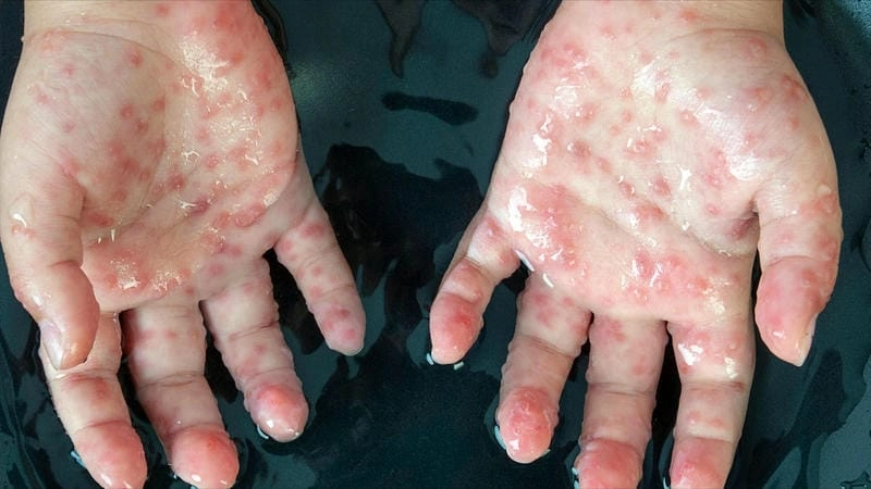 Triệu chứng tay chân miệng cấp độ 1 xuất hiện ở miệng và tay