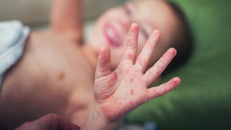 Bệnh chân tay miệng cấp độ 1 khởi phát với dấu hiệu nhẹ