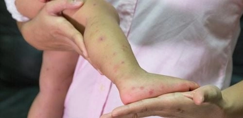 Dấu hiệu rõ qua hình ảnh của bệnh tay chân miệng ở trẻ