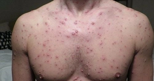 Những hình ảnh bị thủy đậu giúp nhận diện nhanh khi nghi ngờ