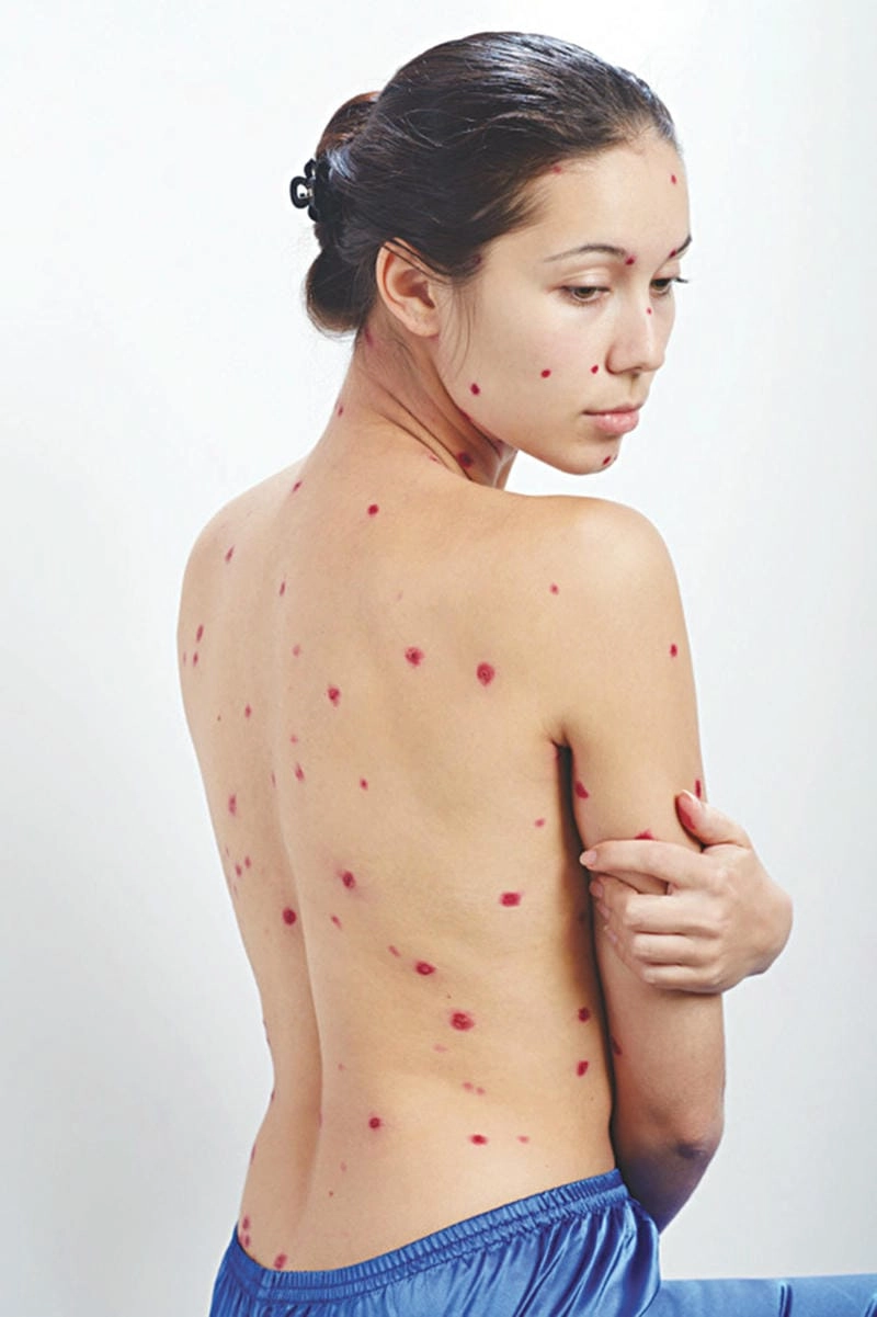 Hình ảnh của bệnh thuỷ đậu giúp nhận biết mức độ tổn thương