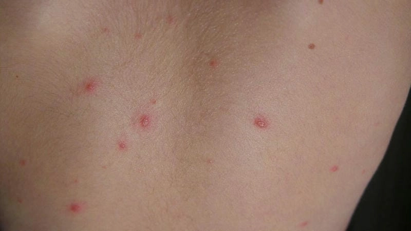 Ảnh bệnh thủy đậu cho thấy tình trạng da nổi hồng ban