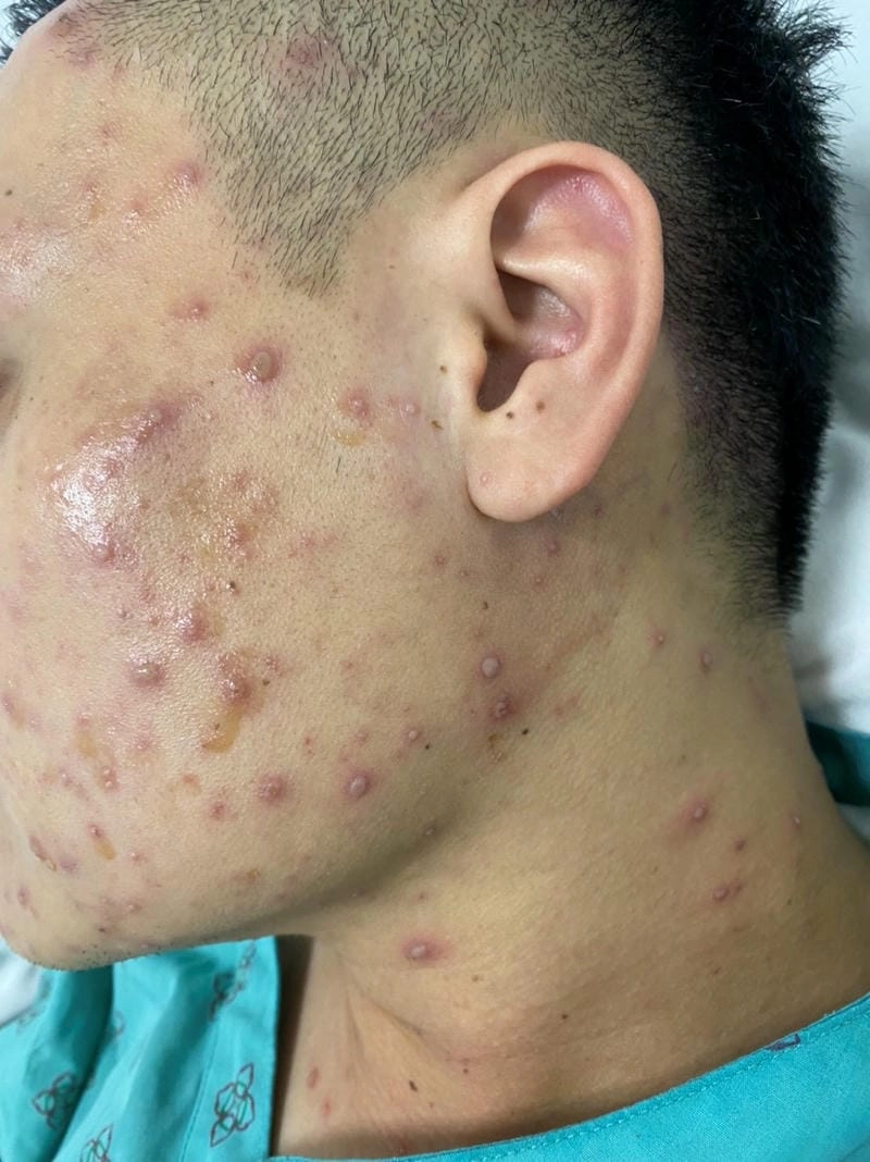 Hình ảnh của bệnh thủy đậu phản ánh diễn biến theo từng ngày